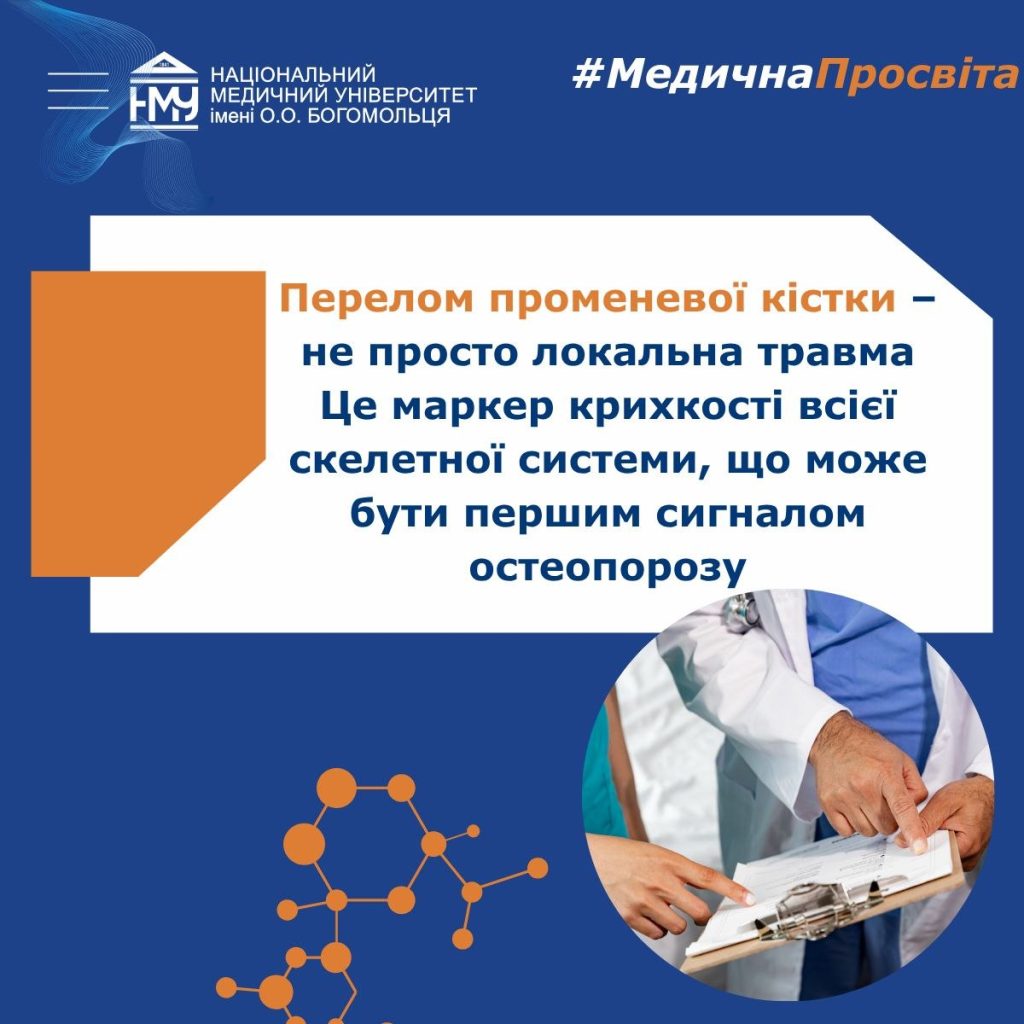 Перелом променевої кістки: чому ця травма може бути першим симптомом остеопорозу